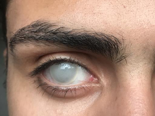 Kingdom 2 SFX Lenses | 1 Year Secondary image